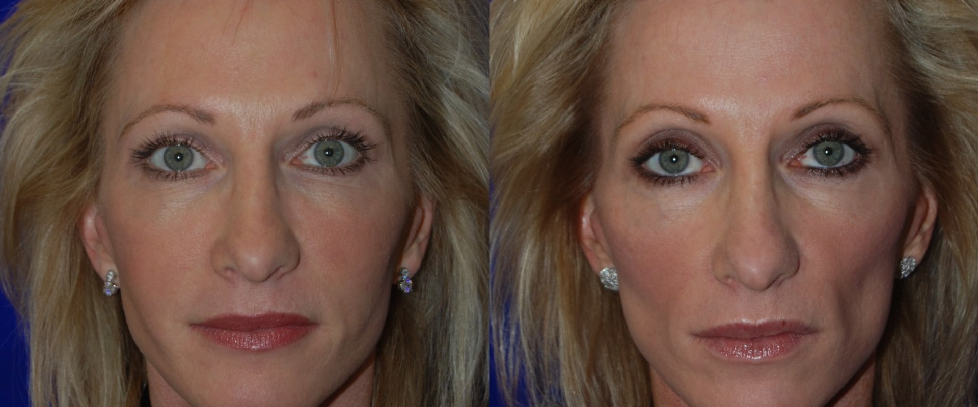 When Will I See Results from Juvederm?