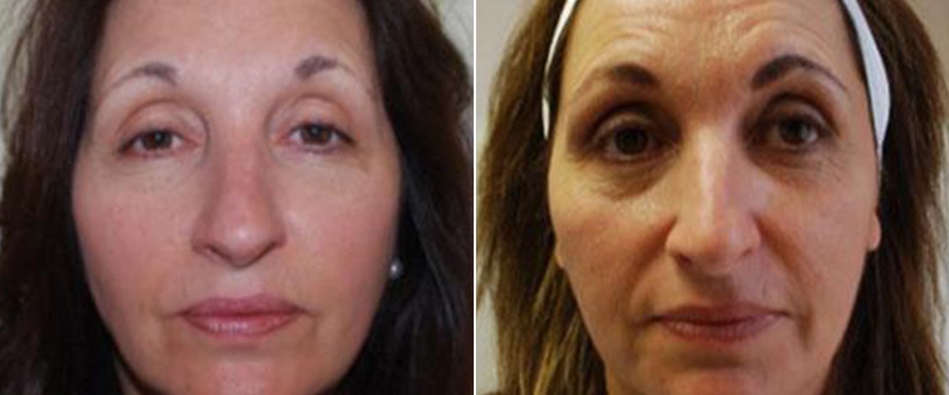 Why is Juvederm Voluma So Expensive? A Comprehensive Guide