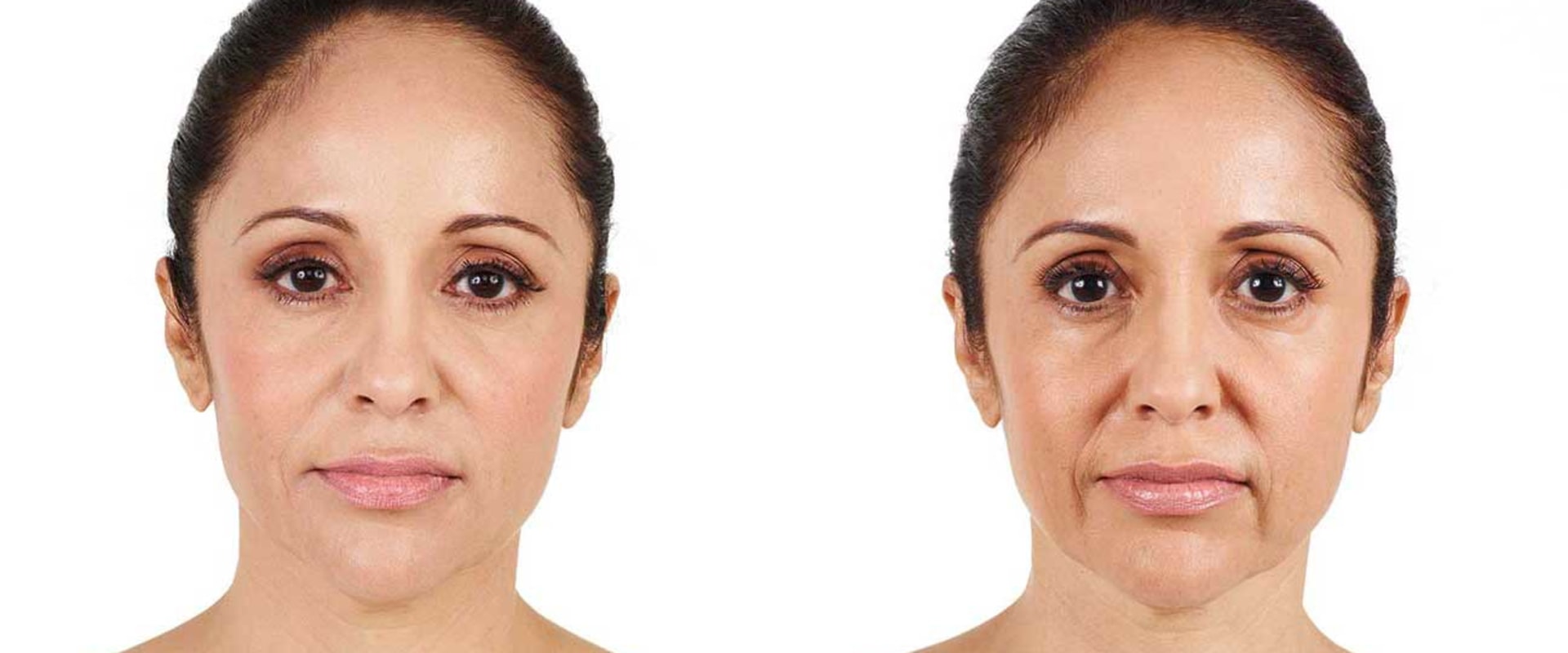 The Risks of Juvederm: What You Need to Know