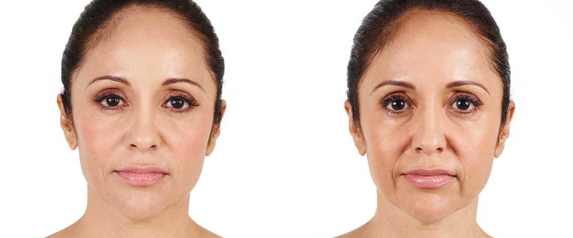 Why is juvederm bad?