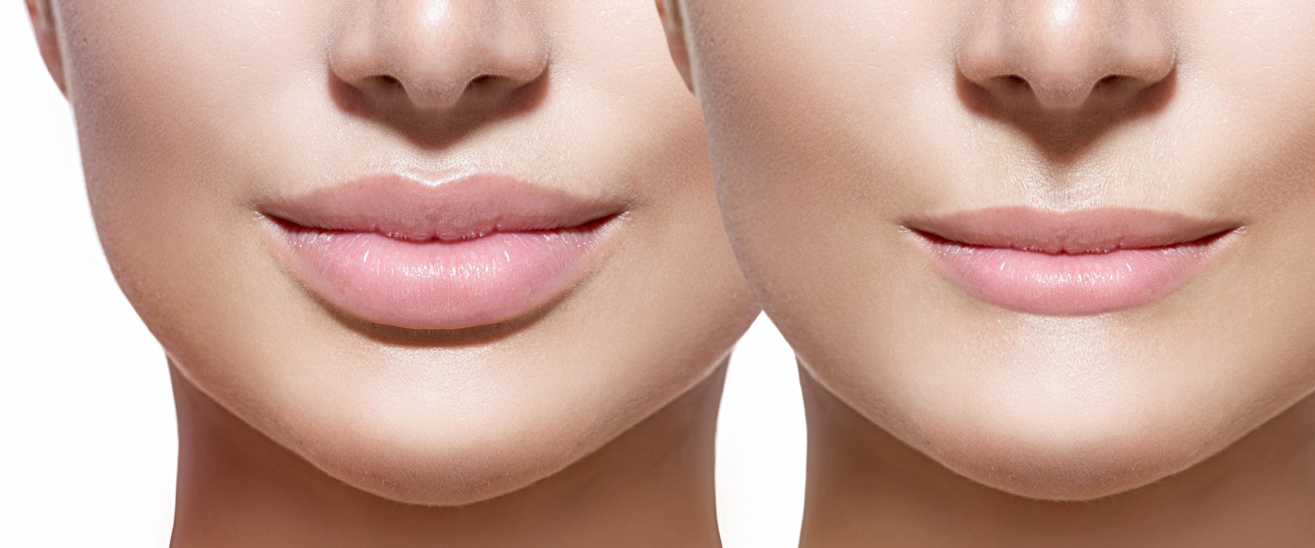 Juvederm for Lip fillers