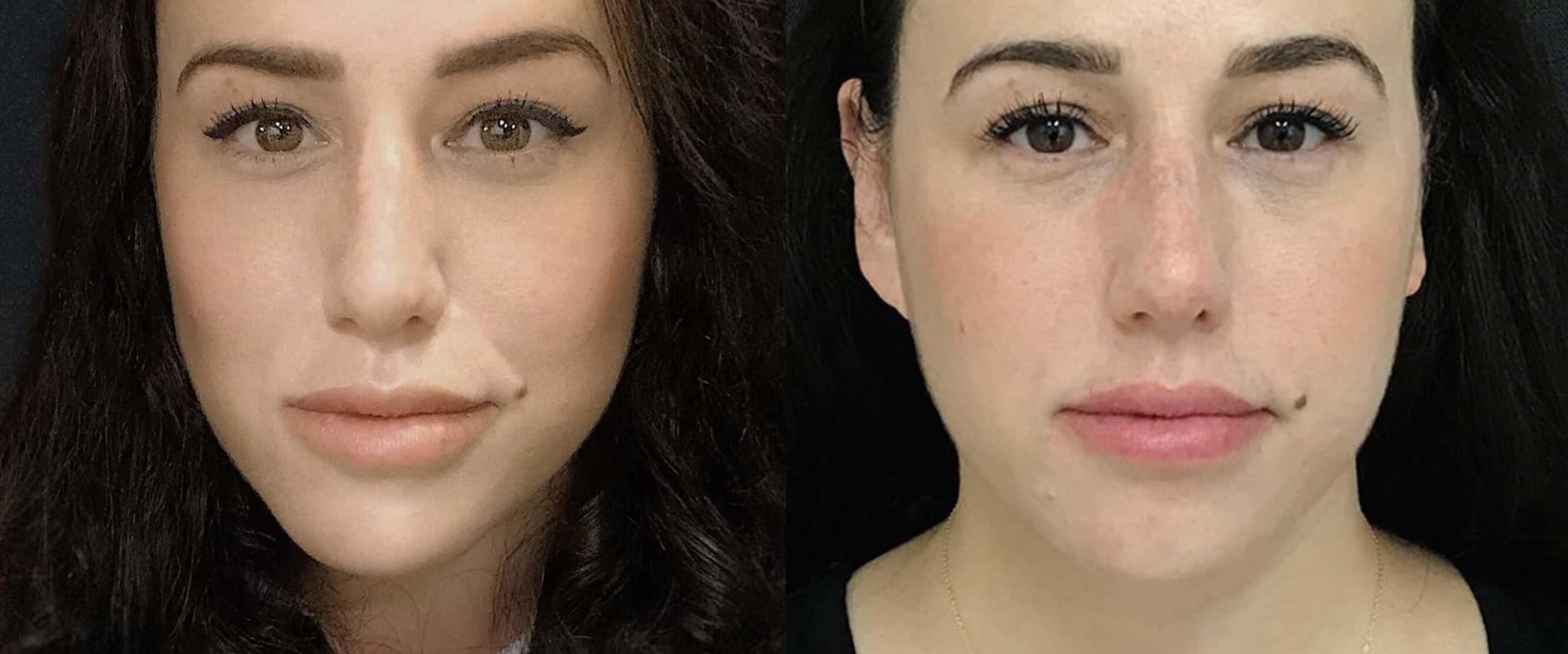 What Juvederm is Best for Cheeks? A Comprehensive Guide