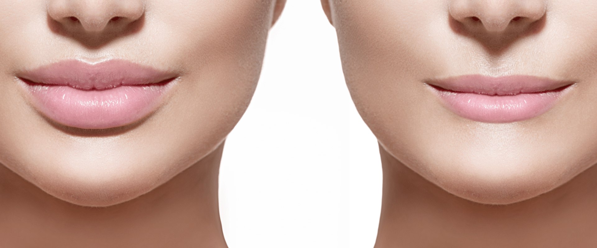 Which juvederm is used for lips?