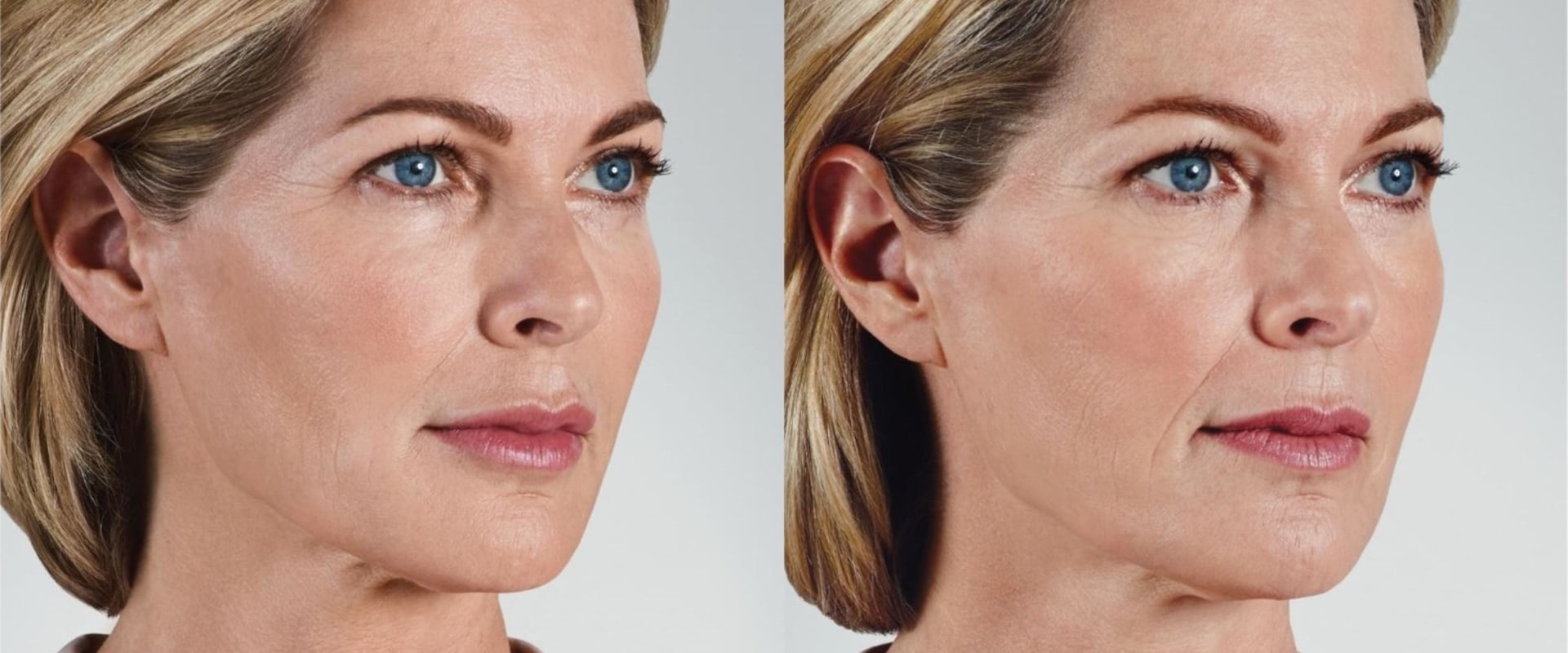 Can you use juvederm between your eyebrows?