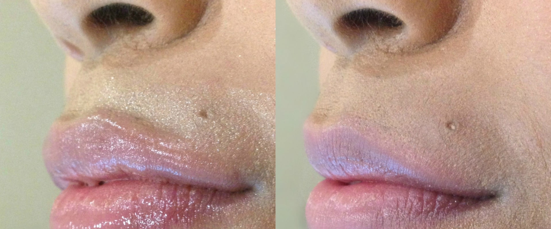 How Much Does a Syringe of Juvederm Cost?