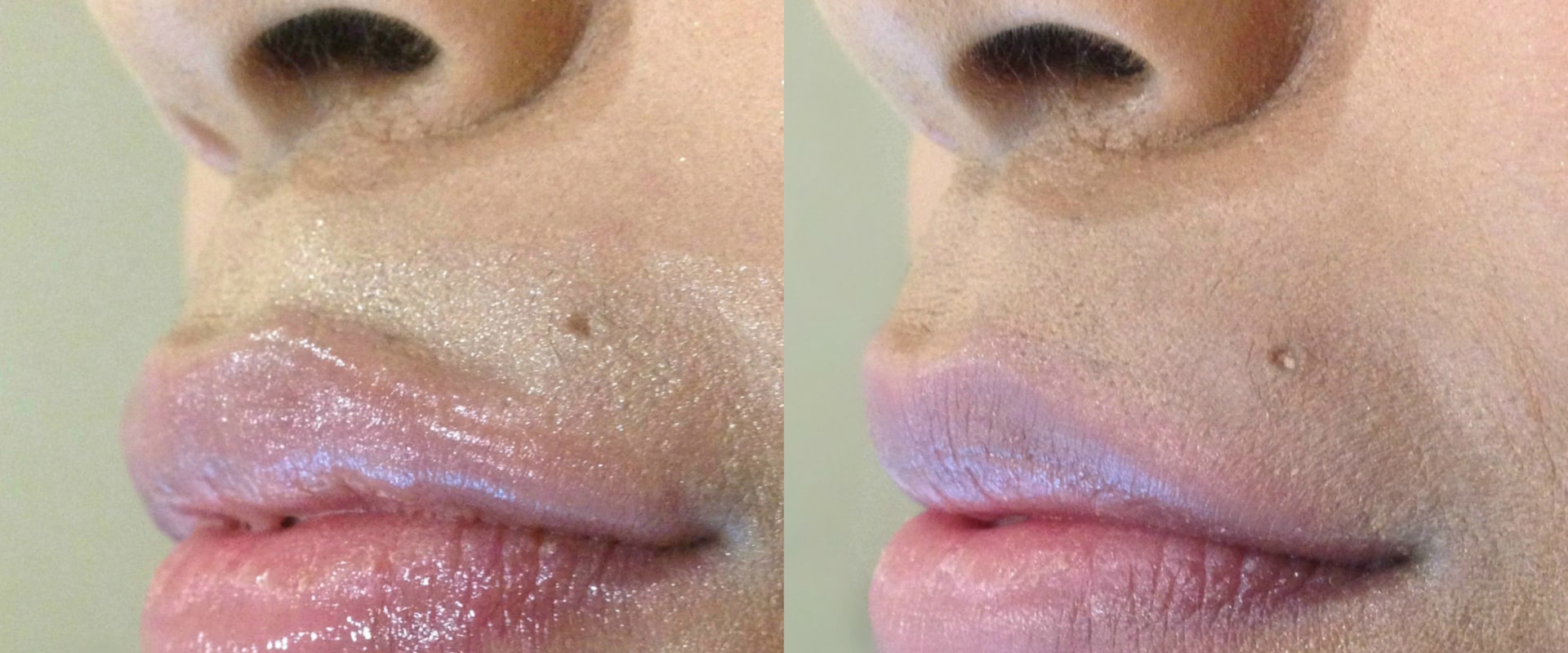 How much does a syringe of juvederm usually cost?
