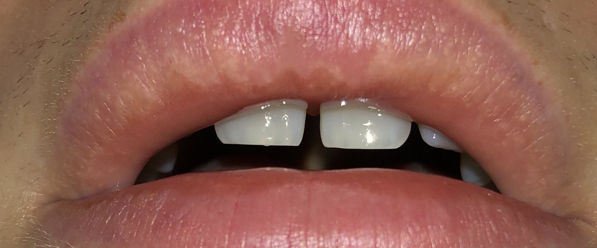 Will Juvederm Bumps Disappear?