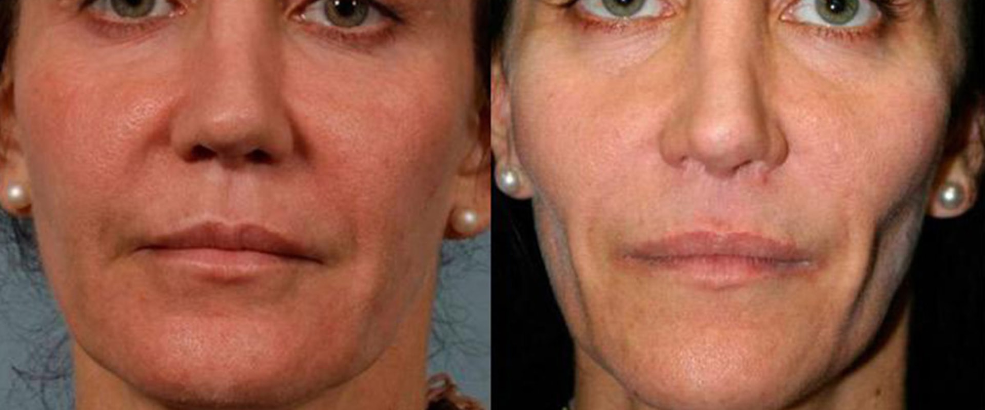 How Much Does Juvederm Cost? An Expert's Guide