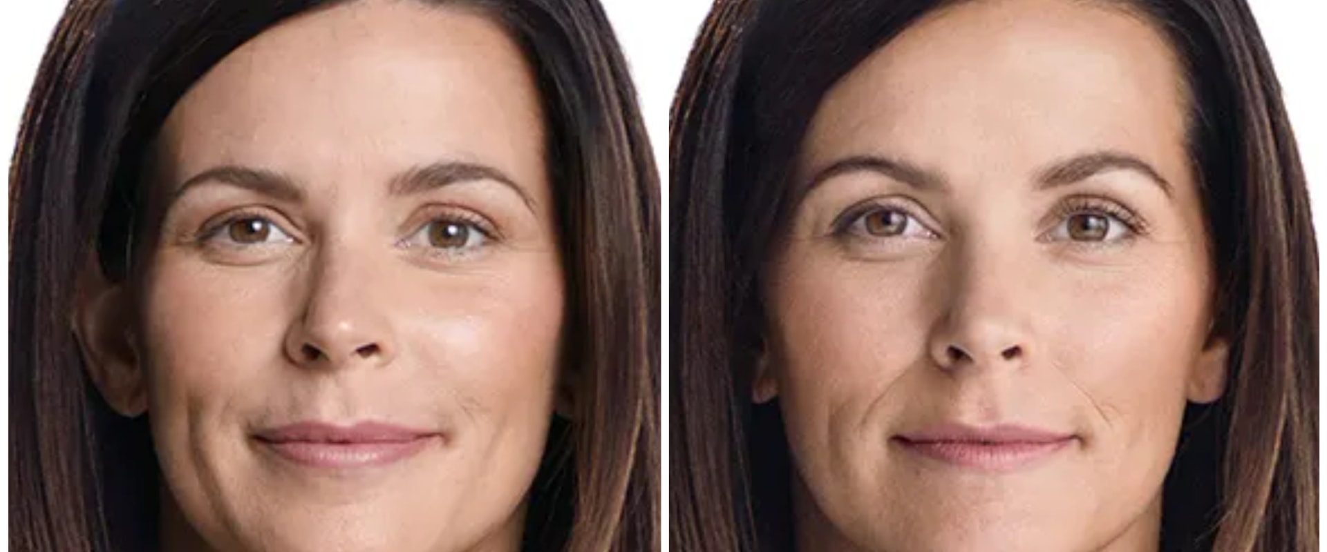 Are Juvederm Fillers Safe? An Expert's Perspective