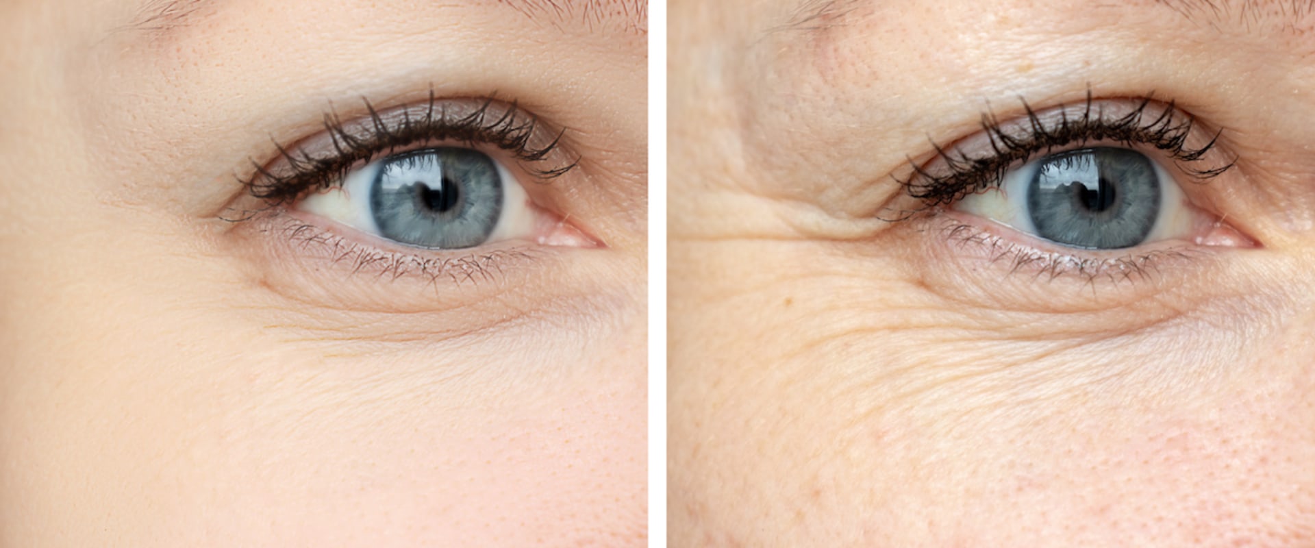 What is the Difference Between Botox and Juvederm?