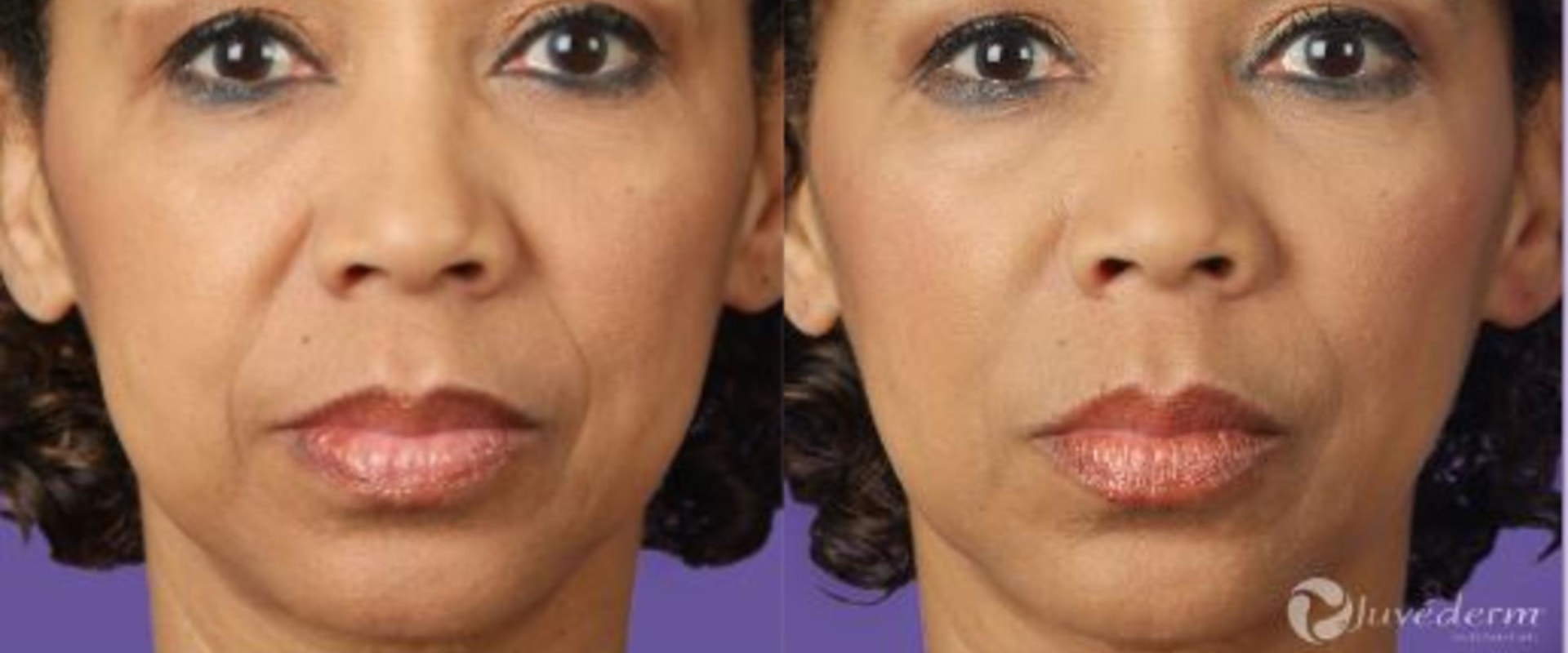 How Long Does Juvederm Take to Settle? A Comprehensive Guide
