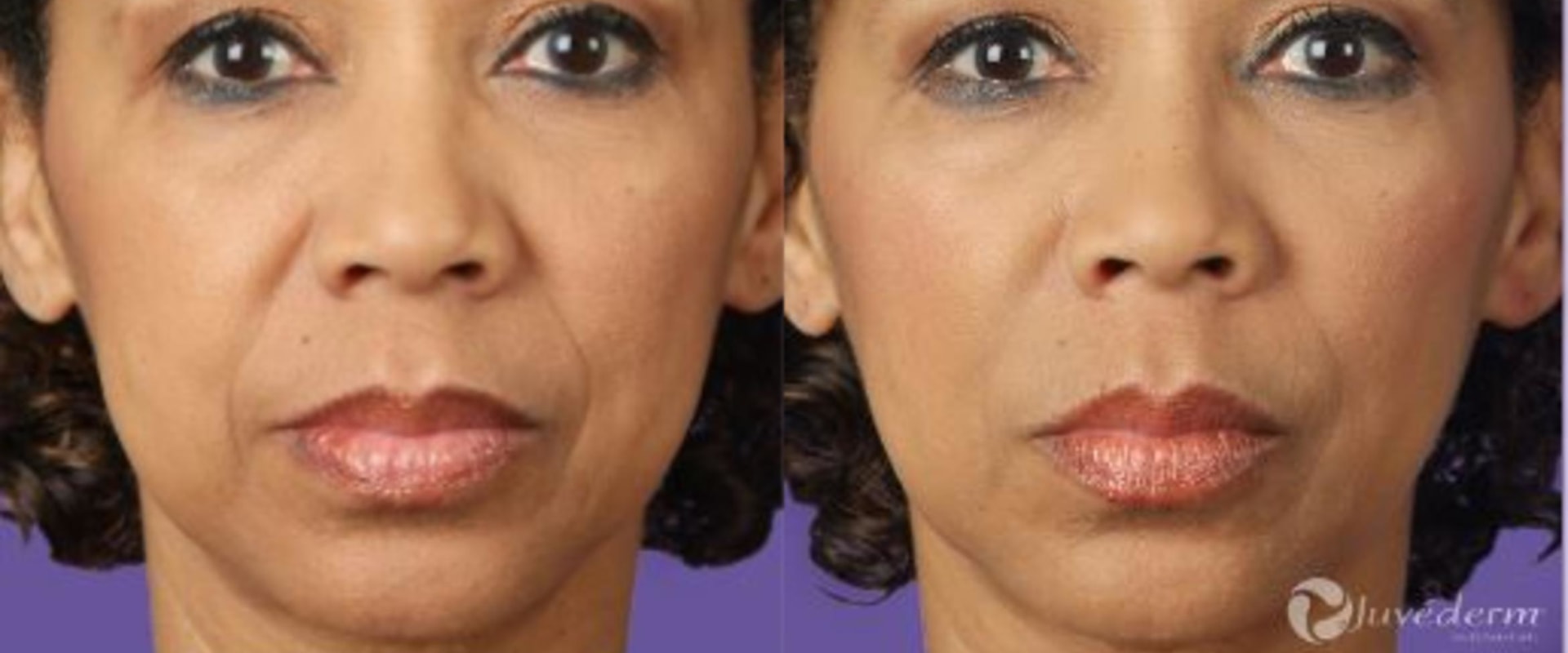 How long does juvederm take to settle?
