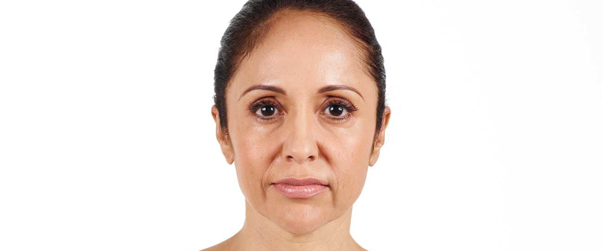 Are Juvederm and Restylane the Same Thing?
