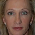 When Will I See Results from Juvederm?