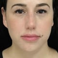 What juvederm is best for cheeks?