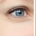 Are Juvederm and Botox Different Treatments for Wrinkles?