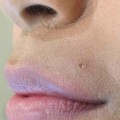 Why Do Juvederm Injections Cause Bumps and Lumps?