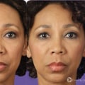 How Long Does Juvederm Take to Settle? A Comprehensive Guide