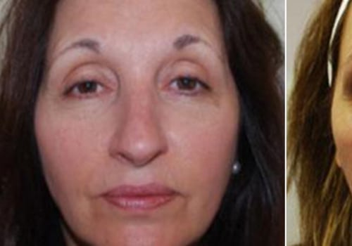 Why is Juvederm Voluma So Expensive? A Comprehensive Guide