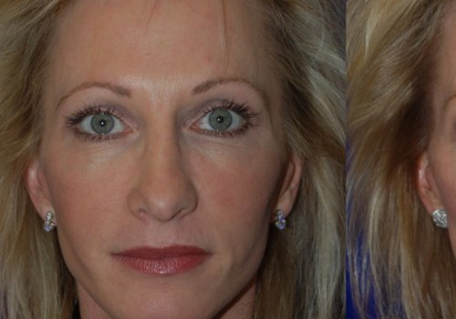 What is Juvederm Voluma and Who Makes It?