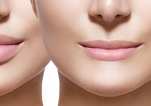 Juvederm for Lip fillers