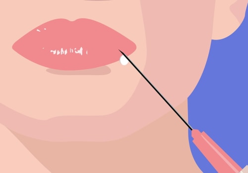 What areas of the face can you use juvederm?