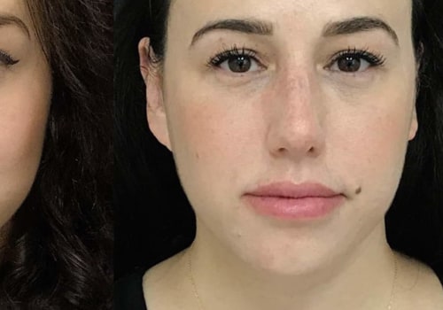 What Juvederm is Best for Cheeks? A Comprehensive Guide