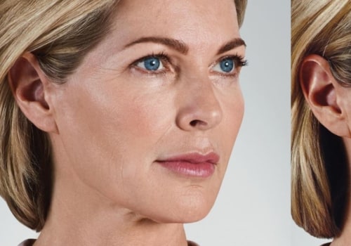 Can Juvederm Help You Get Rid of Glabellar Lines?