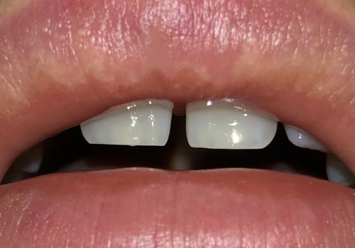 Will Juvederm Bumps Disappear?