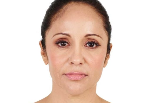 What is Juvederm and Where is it Made?