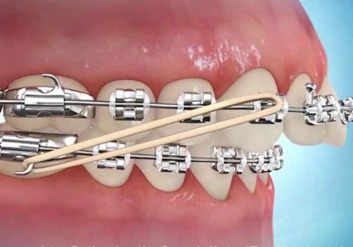 How Many Syringes of Juvederm Do You Need for Best Results?