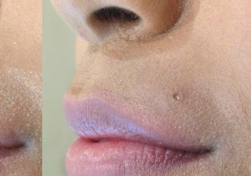 Why does juvederm cause bumps?
