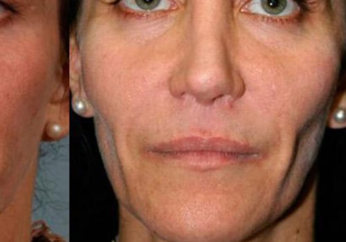 How Much Does Juvederm Cost? An Expert's Guide