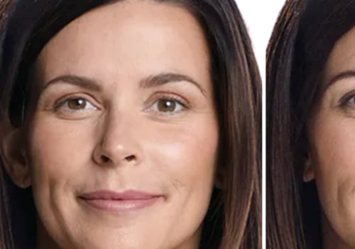 Are Juvederm Fillers Safe? An Expert's Perspective