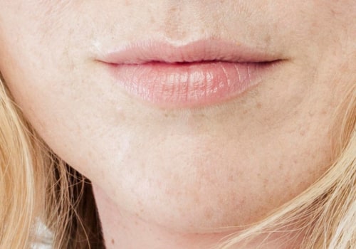 Why is Juvederm So Expensive? An Expert's Perspective