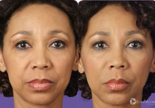 How Long Does Juvederm Take to Settle? A Comprehensive Guide